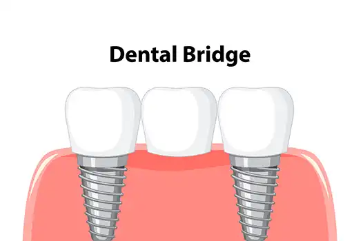 what is dental bridge